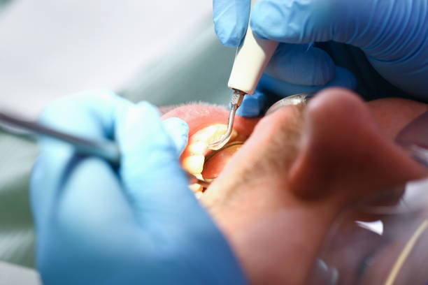 Best Emergency Root Canal Treatment in Sebastian, FL